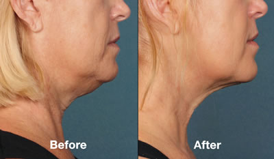 Before & After Kybella