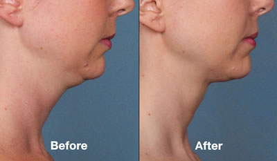 Before & After Kybella