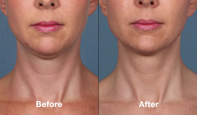 Before & After Kybella