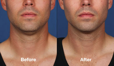 Before & After Kybella