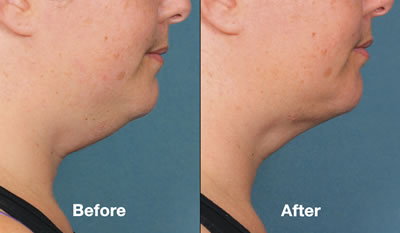 Before & After Kybella